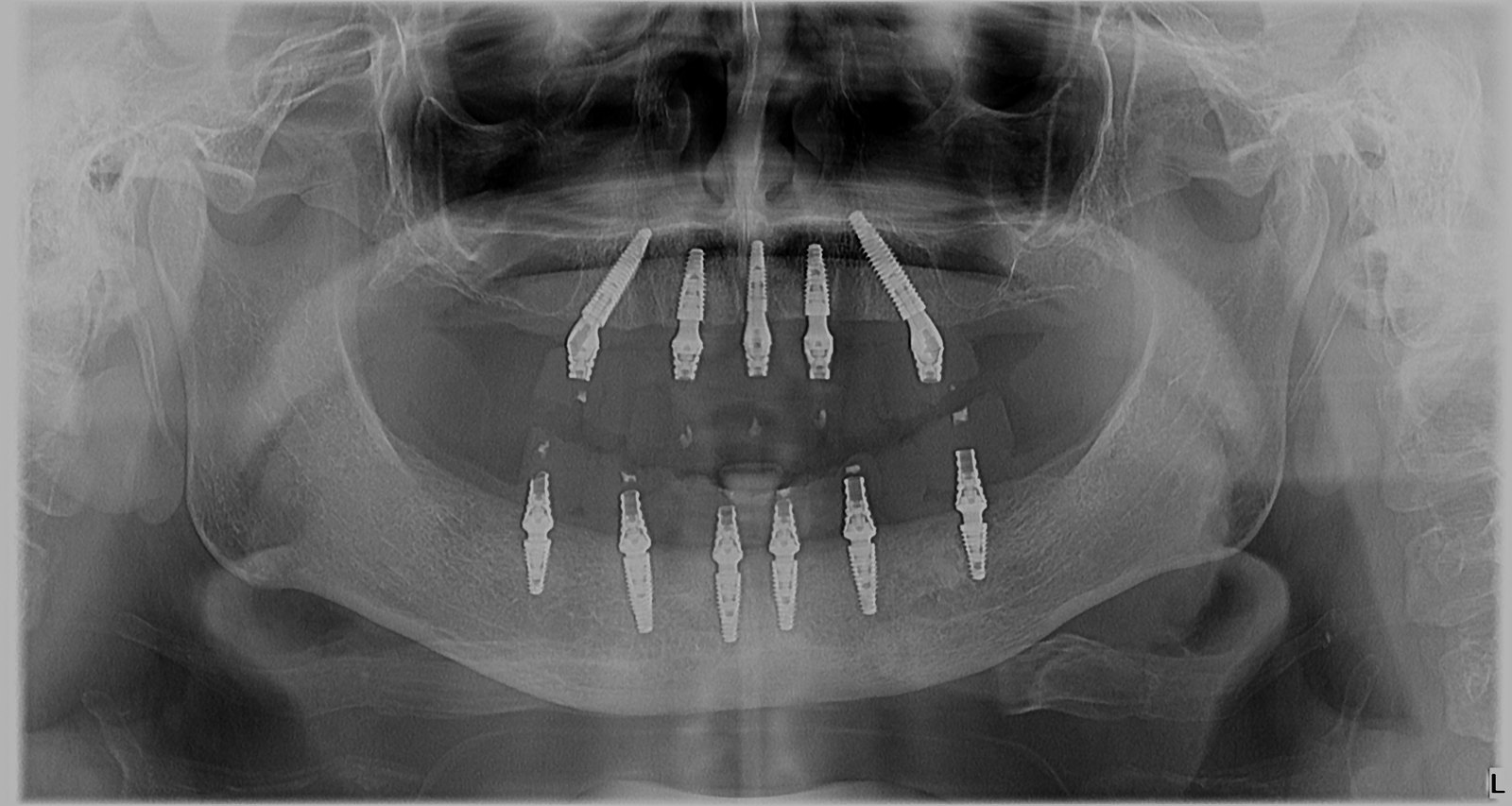Radiografie panoramică anonimizată cu implanturile