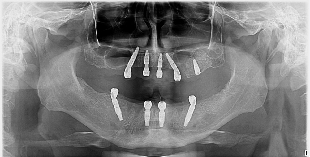 Radiografie panoramică anonimizată cu implanturile
