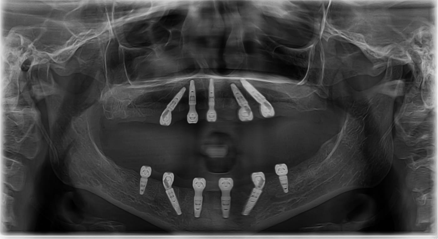 Radiografie panoramică anonimizată cu implanturile
