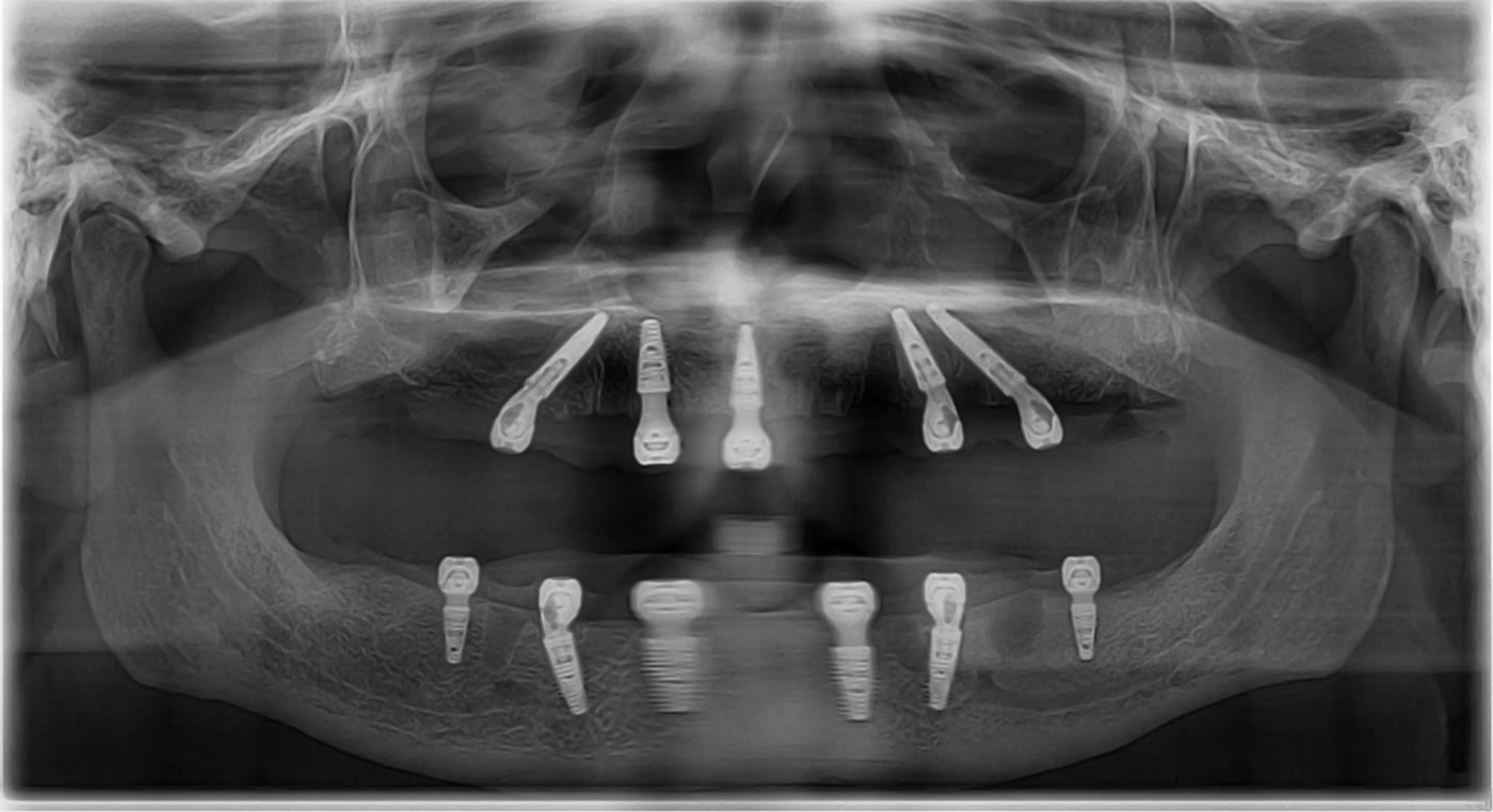 Radiografie panoramică anonimizată cu implanturile