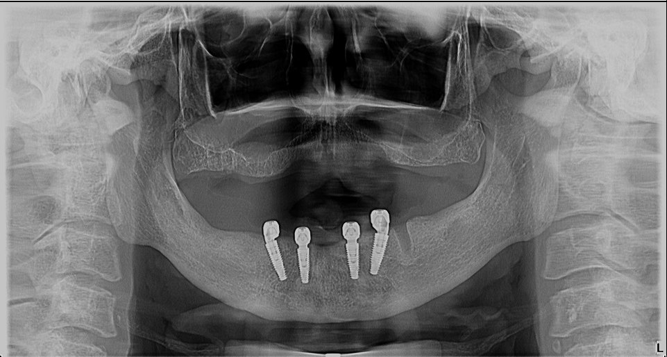 Radiografie panoramică anonimizată cu implanturile