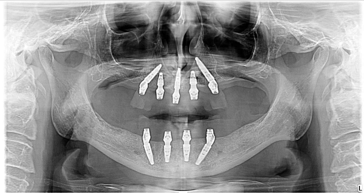 Radiografie panoramică anonimizată cu implanturile